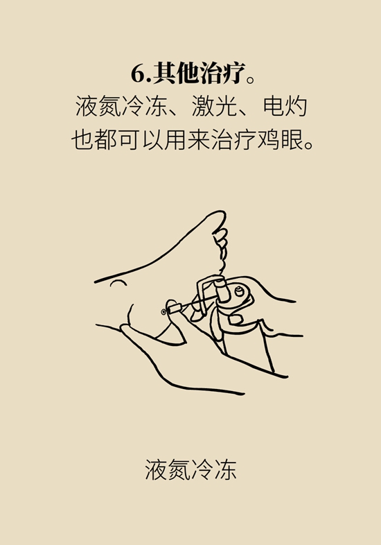 長(zhǎng)了雞眼和老繭怎么辦？這份防治指南請(qǐng)收好