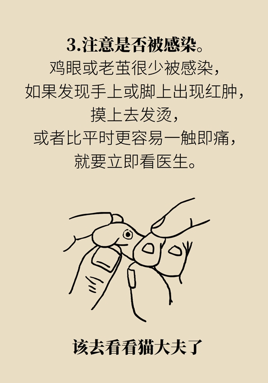 長(zhǎng)了雞眼和老繭怎么辦？這份防治指南請(qǐng)收好